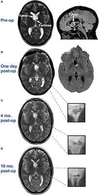 Memory deficit following resection of an intraventricular myxoid glioneuronal tumor impinging on the bilateral fornix: A case report